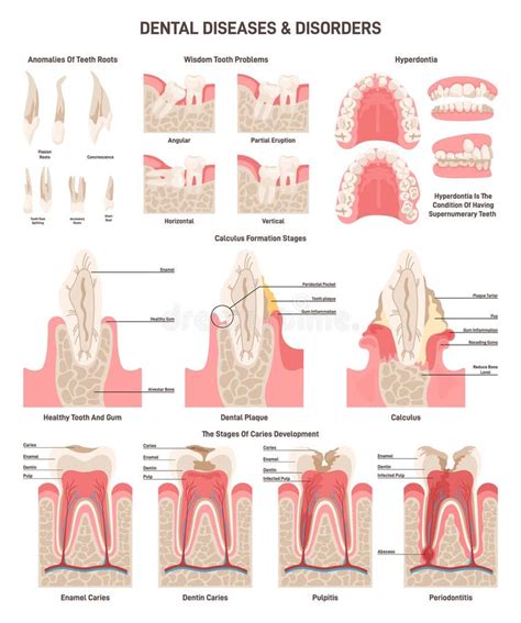 Trastorno Dental Cavidad Oral Y Enfermedades Dentales Humanas Encías