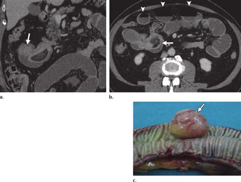 Intussusception In A 50 Year Old Man With Nausea Vomiting And