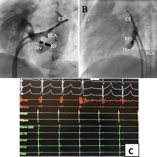 D Electro Anatomical Activation Map Of A Para Hisian Accessory Pathway