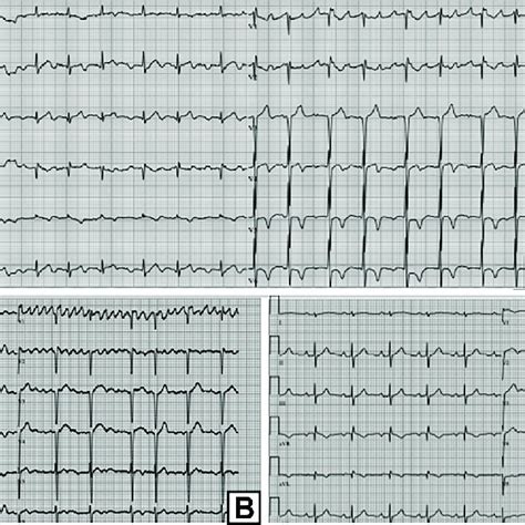 Twelve Lead Electrocardiograms A Atrial Tachycardia With Monomorphic