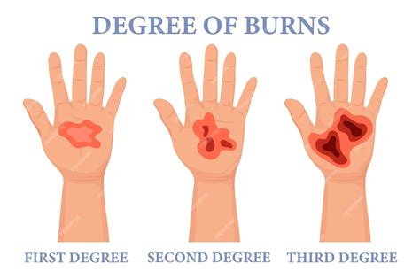 First Degree Burns On Hands