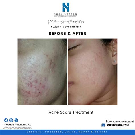 Acne Scars Treatment In Islamabad Shahhassanchowdry Medium