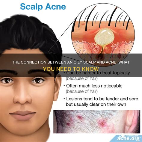 The Connection Between An Oily Scalp And Acne What You Need To Know