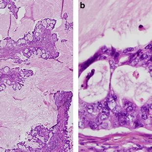 Cribriform Adenocarcinoma Of Lung Showing Tumor Cell Islands With