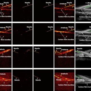 Photoacoustic Pa Imaging With Needle Insertions Into Human Fingers In