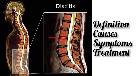 Diskitis Causes Symptoms Treatment Youtube