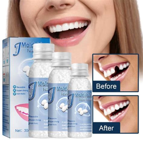 【fast Filling】temporary Tooth Repair Kit Teeth And Gaps Moldable