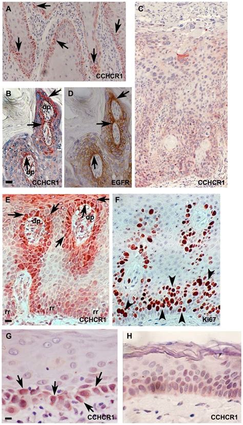 Expression Of Cchcr1 In Bowen S Disease Psoriasis And Actinic Download Scientific Diagram