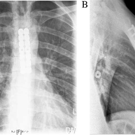 X-ray demonstrating anterior dislocation of the sternomanubrial joint. | Download Scientific Diagram