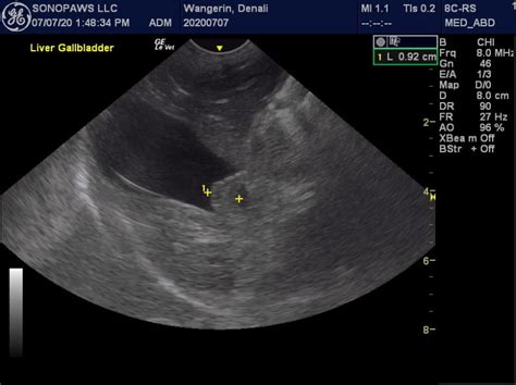 Gallbladder polyp? - Members