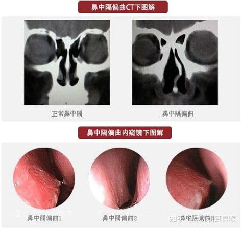 头晕头痛、鼻塞流涕，可能是鼻中隔偏曲的典型症状 知乎