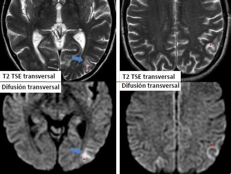 LEUCOENCEFALOPATÍA MULTIFOCAL PROGRESIVA Seram