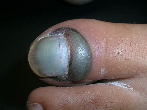 Crushing of the thumb, with subungual hematoma.