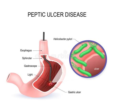 Peptic Ulcer Disease Pud Stomach Ulcer Or Gastric Ulcer Stock Vector Illustration Of