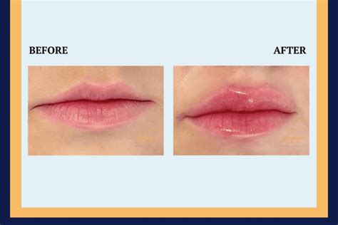 Gorgeous Lips With Aftercare For Lip Filler