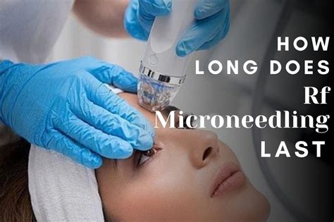 How Long Does Rf Microneedling Last Fitness Beauty Art