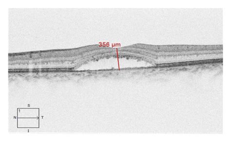 A 50 Year Old Male Patient Who Underwent Half Dose PDT Ac FFA