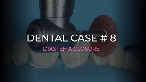 Dental Case Diastema Closure With Direct Composite Youtube