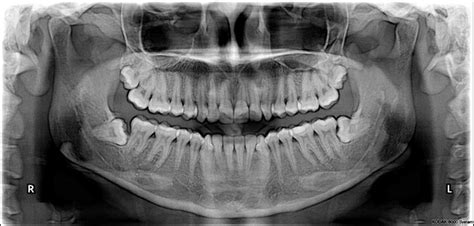 Radiografía Panoramica en Odontología Dento Metric Radiología