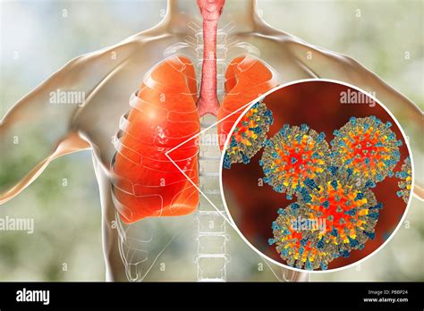 Neumon A Causada Por Virus Del Sarampi N Fotograf As E Im Genes De Alta