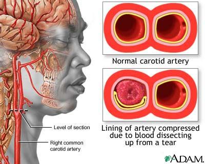 Megan's CT/MRI Pathology: Dissection of Carotid Artery