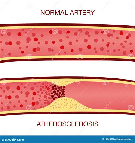 Atherosclerosis Illustration Cartoon Vector | CartoonDealer.com #51840093