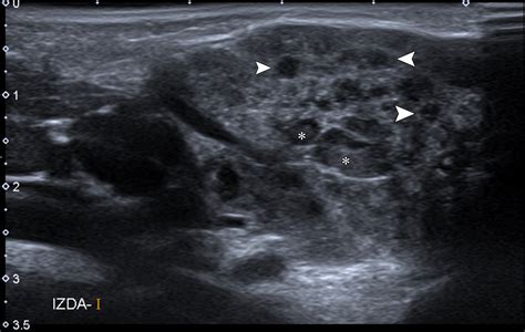 Imaging Evaluation of Pediatric Parotid Gland Abnormalities | RadioGraphics