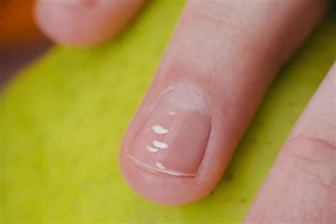 5 Causes For White Spots On Nails And How To Treat Them