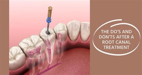 The Dos And Donts After A Root Canal Treatment Expert Dental Care