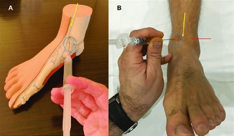 Tibialis Anterior Tendon Foot