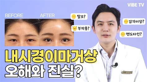 내시경이마거상 오해와 진실 팩트체크 해드립니다 탈모 부작용 감각이상 엔도타인 등 Youtube