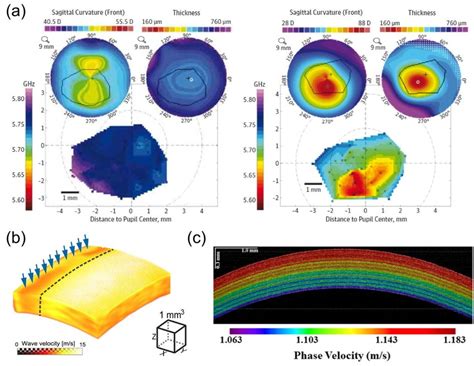 A In Vivo Brillouin Microscopy Of Normal Left And Keratoconus