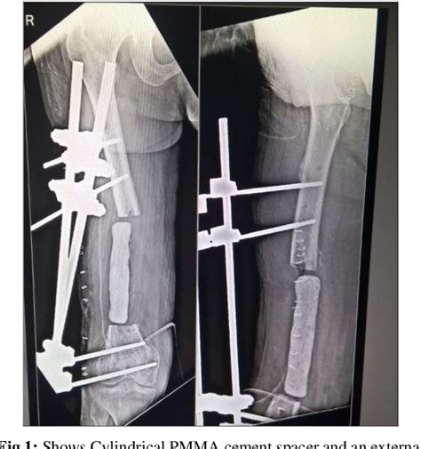 Figure 1 From Non Vascularized Fibular Graft In Management Of Segmental