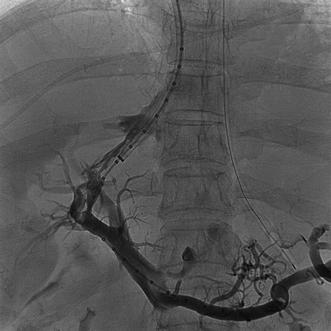 The Transjugular Intrahepatic Portosystemic Shunt An Update Ajr