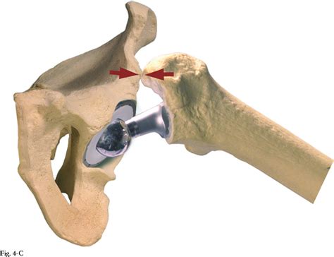 Figure From Impingement With Total Hip Replacement Semantic Scholar