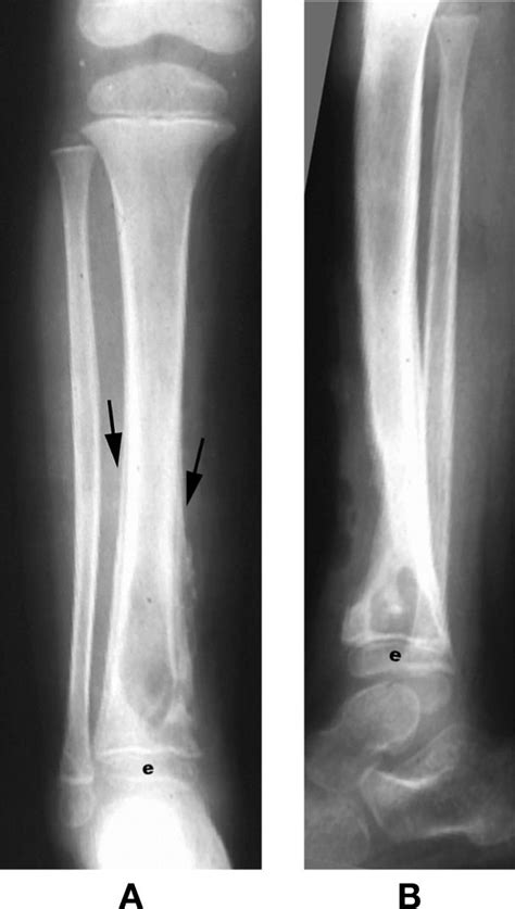 18 Bone Infection Musculoskeletal Key