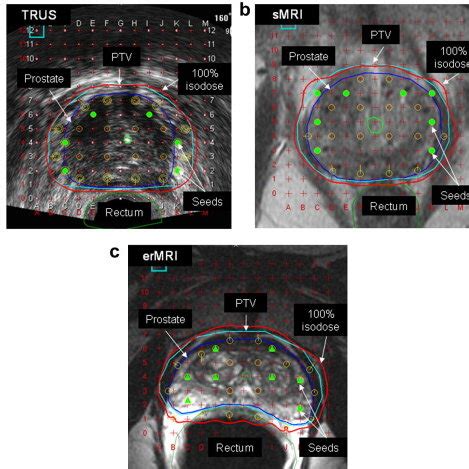 Anatomic Distortion With Endorectal Coil Magnetic Resonance Imaging