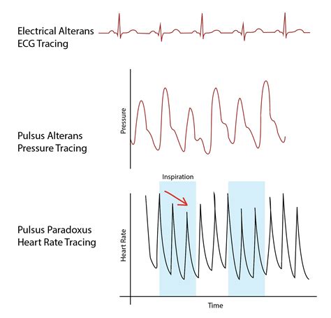 Pulsus Alternans Treatment Management Point Of Care