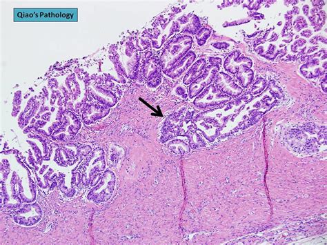 Qiaos Pathology Mucinous Cystadenocarcinoma Of Ovary Flickr