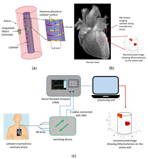 Real Time Detection And 3d Localization Of Coronary Atherosclerosis