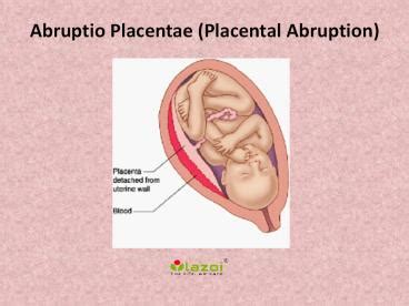 PPT Abruptio Placentae Placental Abruption Overview Of Symptoms