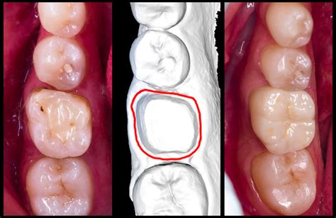 Same Day Cerec Crown Process Step By Step Guide Mda