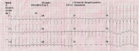 12 Lead ECG Sinus Tachycardia