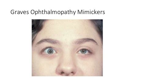 Graves Orbitopathy