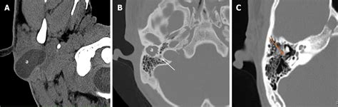 Branchial Cleft Cyst