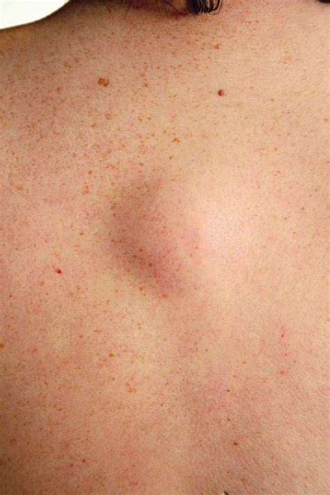 If You See One Of These 18 Bumps On Your Skin Do Not Pop Skin Bumps