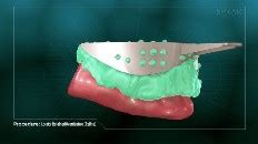 Locator Retained Overdenture (Reline) | Virginia Dental Center