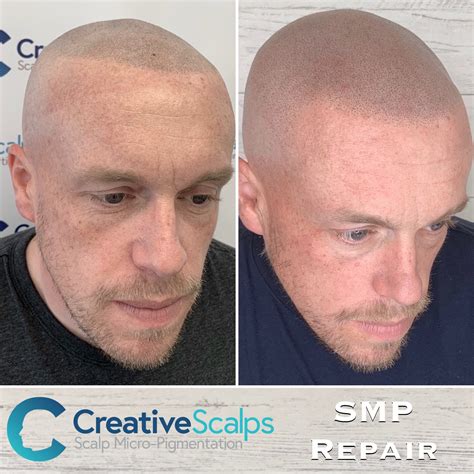 Albums 97 Pictures Scalp Micropigmentation Before And After Pictures