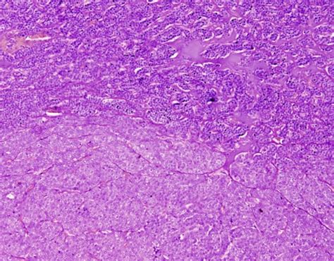 Tumor Cells Arranged In Organoid And Nesting Pattern Separated By Thin