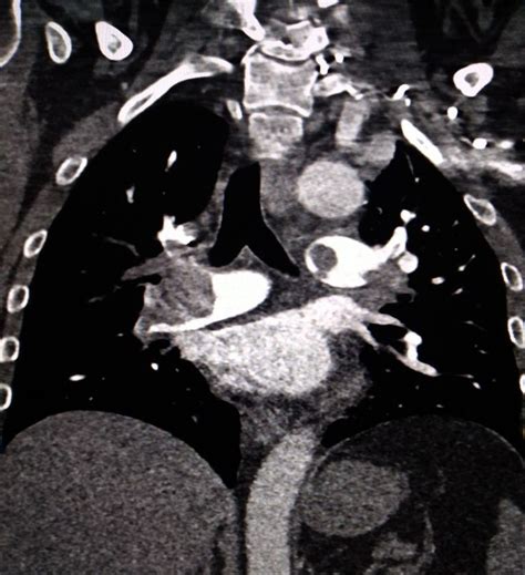 Pulmonary thromboembolism | Radiology, Pulmonary, Case